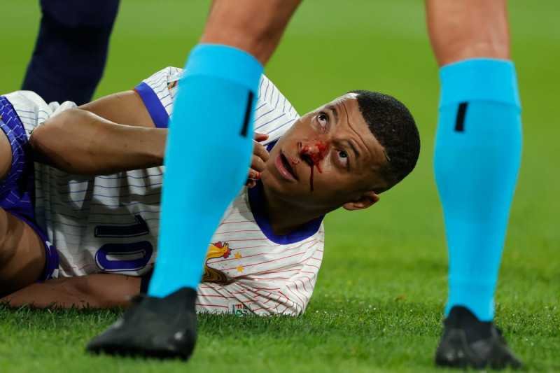 Mbappe: Deschamps provides concerning update on nose injury